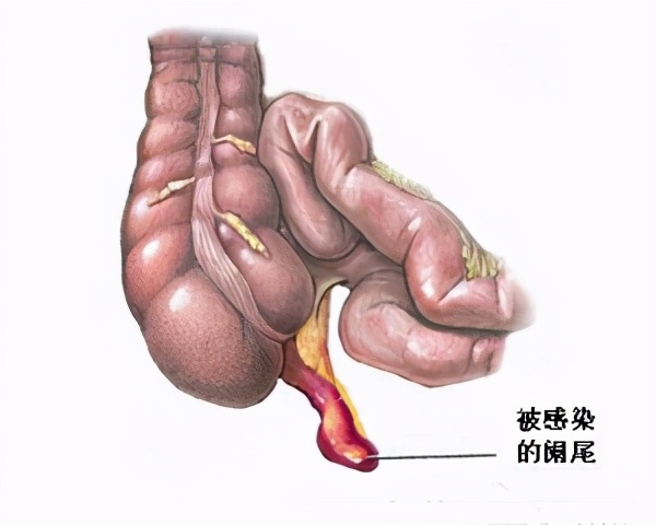 阑尾位置解剖图片